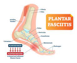 plantar fasciitis 10 tools for