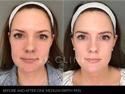 Learn more about the best solutions for skin hyperpigmentation as well as what causes it. Slk Nashville Chemical Peels For Sun Spots Brown Spots And Melasma