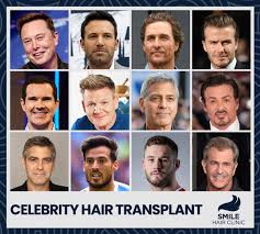 celebrities hair transplants smile