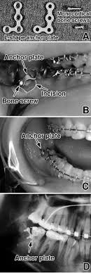 Modern and comfortable dental office environment. Distal Movement Of Mandibular Molars In Adult Patients With The Skeletal Anchorage System American Journal Of Orthodontics And Dentofacial Orthopedics