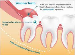 Tooth Pain Due To Wisdom Teeth gambar png