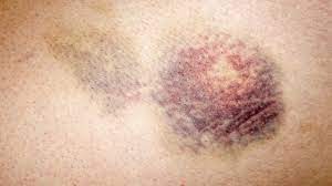 leukemia rashes and bruises symptoms