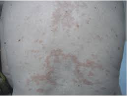 Granuloma annulare (ga) is skin disorder that most often causes a rash with red bumps (erythematous papules) arranged in a circle or ring pattern (annular). Disseminated Granuloma Annulare Lesions On Trunk Download Scientific Diagram