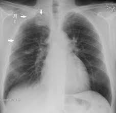 1800 mesothelioma + 2 mesothelioma 1 year survival rate mesothelioma 10 year survival rate mesothelioma 100 success fee. Malignant Mesothelioma Imaging Practice Essentials Radiography Computed Tomography