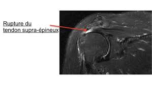 In a complete rupture the ability to extend that knee is decreased. La Rupture De La Coiffe Des Rotateurs Clinique De L Epaule Du Coude