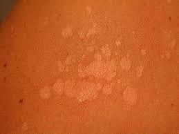 tinea versicolor causes diagnosis