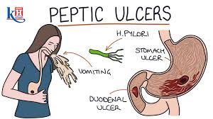 understanding peptic ulcers causes