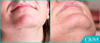unwanted hair from upper lip chin