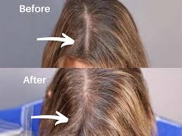 Best cbd oils for hair loss in 2020 when buying cbd oil, you shouldn't act on the spur of the moment. Fascinating Mesotherapy For Hair Tactics That Can Help Your Hair Grow