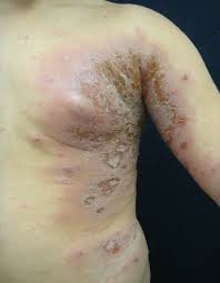skin manifestations ociated with hiv