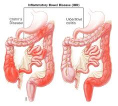 Inflammatory Bowel Disease Ibd Diagnosis And Treatment