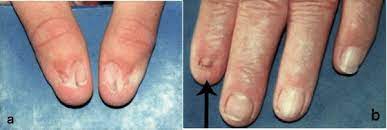 nail patella syndrome medlineplus genetics