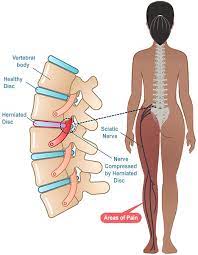 lumbar disc herniation frequently
