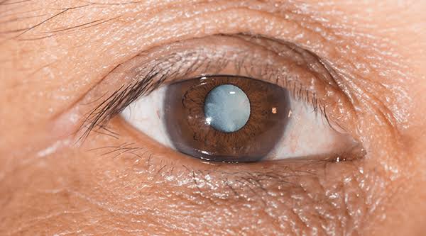 How To Cure Cataract And Glaucoma In A Natural Way