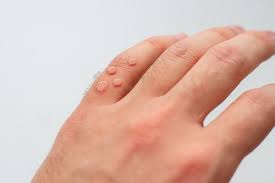 5 treatment options for stubborn warts