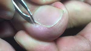 people removing their ingrown toenails