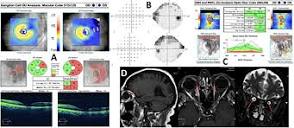 Frontiers | Bilateral optic nerve sheath meningocele: clinical aspects