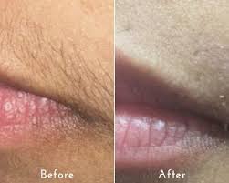 laser hair removal at laser skin