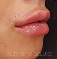 Lippenvolumen mit dem hyaluron pen von urban spa! Galerie Bilder Voher Nachher Aesthetic Deluxe Koln