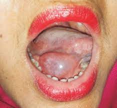 cystic swelling in the floor of the mouth