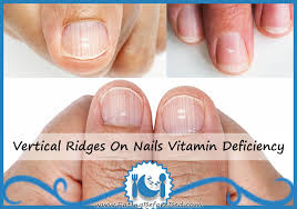 vertical ridges on nails vitamin deficiency