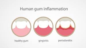 inflamed gums causes treatments