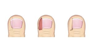 ingrown toenail management the