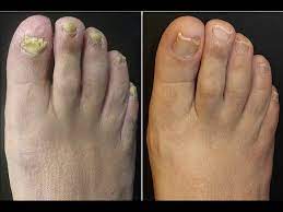 toenail fungus treatment listerine