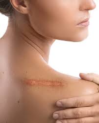 keloid excision treatment in hyderabad