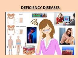 Vitamins and minerals in adequate amounts are necessary for good health, and help in the prevention of diseases. Deficiency Diseases In Nutrition Class Vi