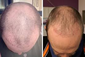 hair transplant after 2 months photos