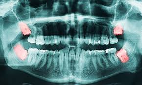 wisdom tooth 9 warning signs you