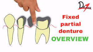 fixed partial denture overview