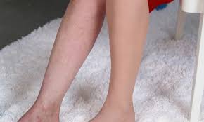 how to cover up spider veins