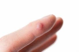 Cravos são consequência da obstrução de folículos na pele, e podem favorecer um quadro de acne. 5 Solucoes Para Eliminar As Verrugas Dos Dedos Melhor Com Saude