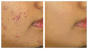 face mask for oily acne e skin
