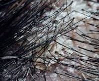 what-causes-severely-dry-scalp