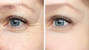 how to treat fine lines under eyes 8