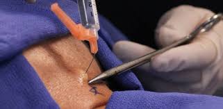 cervical epidural steroid injection