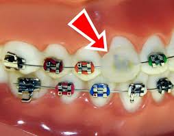 When going through the inconvenience of braces, a couple things are a must: Emergency Care Barton Orthodontics Modesto Ca