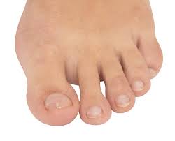 when does an ingrown toenail require