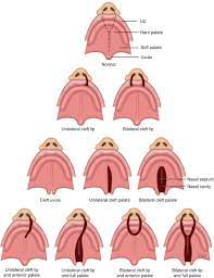 the genetics of cleft