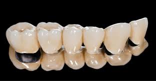 Pfm Crowns Teeth Caps N Crown Dental Art Gallery