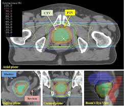 hypofractionated proton therapy