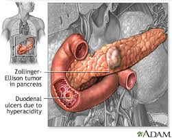 peptic ulcer medlineplus cal