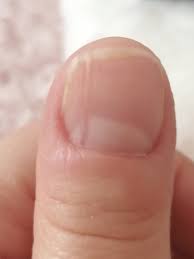 vertical line on my fingernail mumsnet