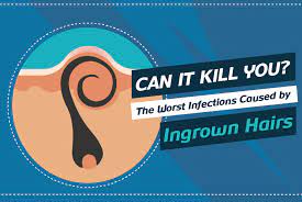 the worst infections caused by ingrown
