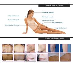 china permanent laser hair removal