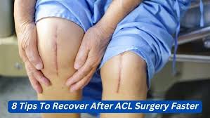 8 tips to recover after acl surgery