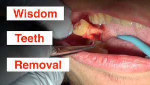 wisdom tooth extraction pain